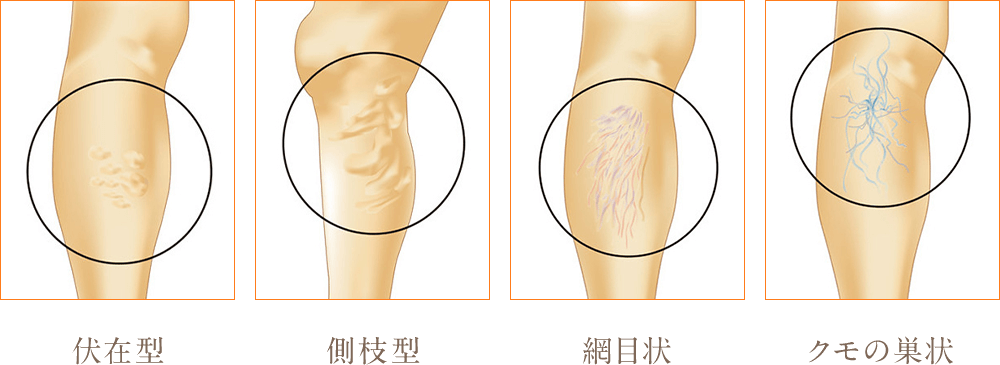 下肢静脈瘤とは？