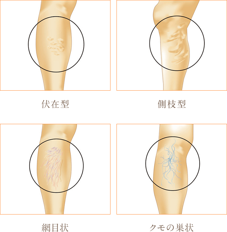 下肢静脈瘤とは？